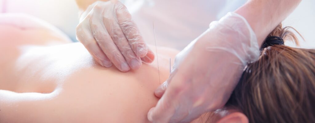 physical-therapy-clinic-dry-needling-sterling-physical-therapy-_-wellness-sugar-land-stafford-bellaire-tx