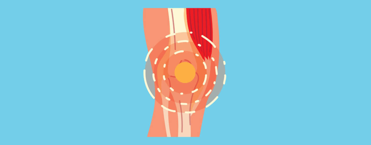 The Role of Inflammation in Knee Pain: Causes and Treatments